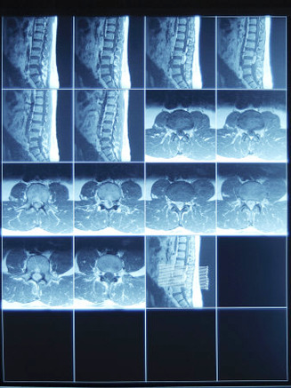 X-Ray Image of Person's Spine on Computer Screen