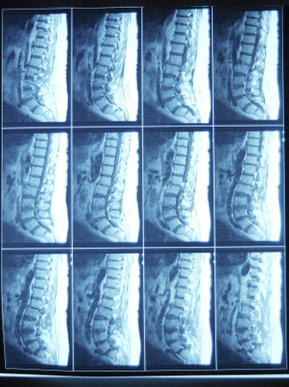 X-Ray Image of Person's Spine on Computer Screen