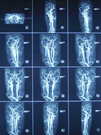 X-Ray Images of Veins on Computer Screen