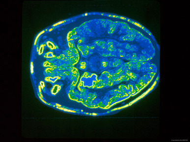 Computer Aided Tomography Imaging Plane Brain Ct